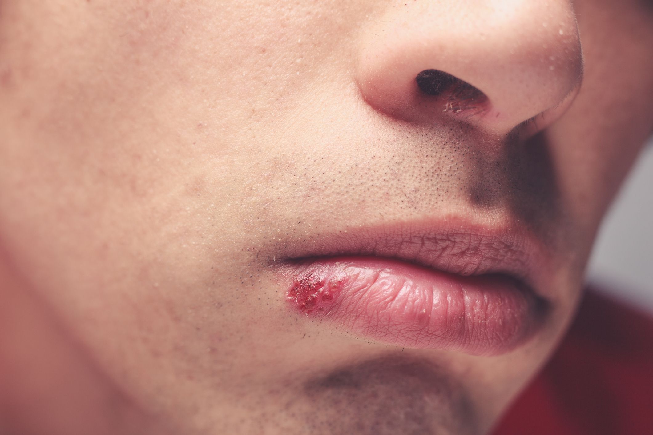 lhp-herpes-labial-capa.jpg